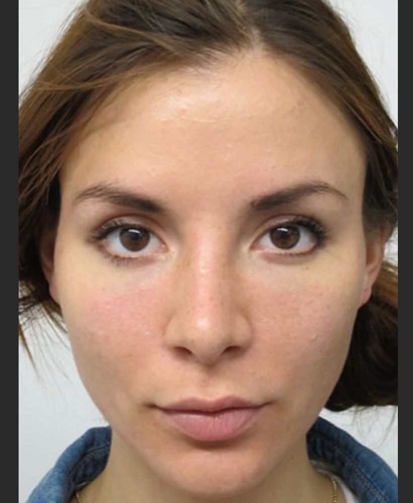 CSD CLINICS | Dermal Filler