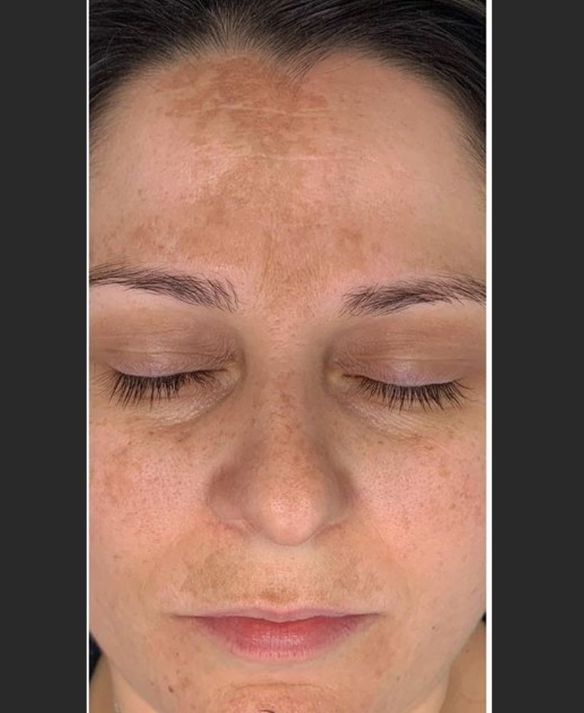 CSD CLINICS | Pigmentation