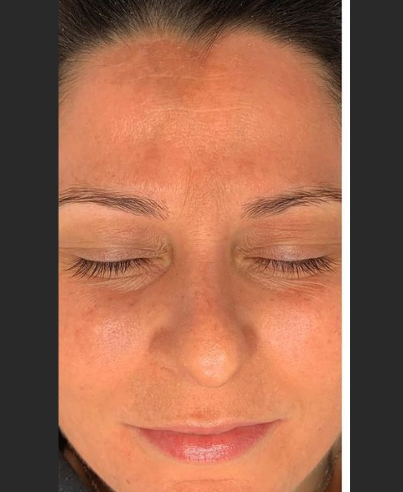 CSD CLINICS | Pigmentation