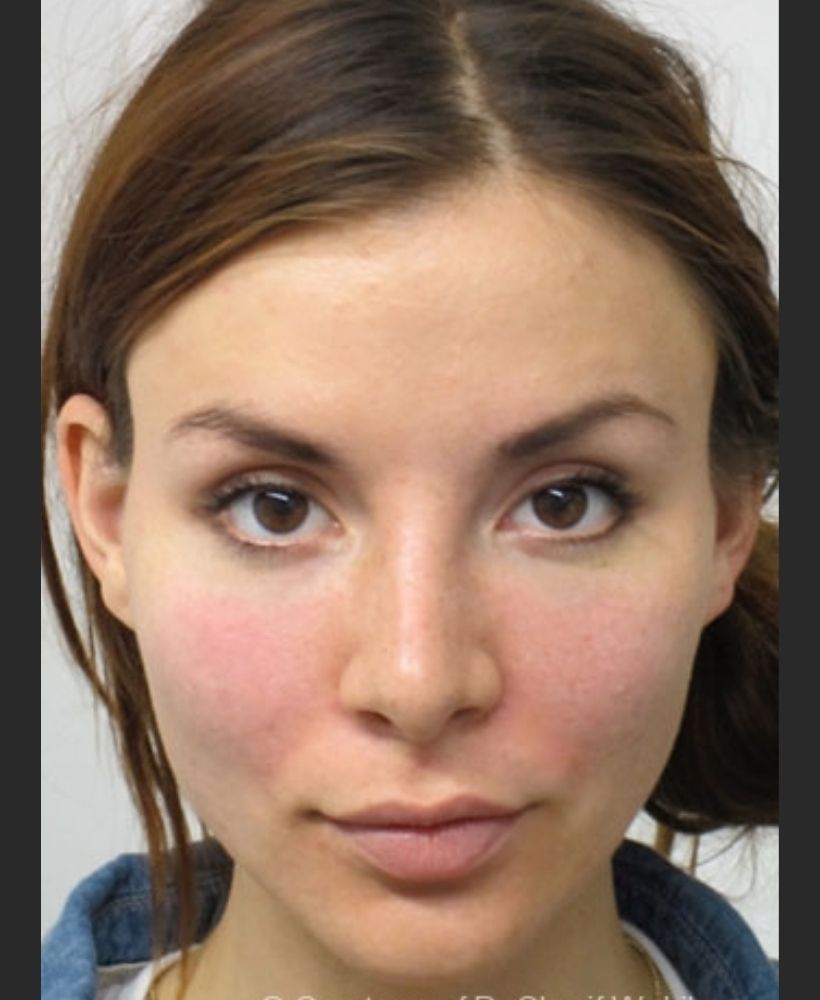 CSD CLINICS | Dermal Filler