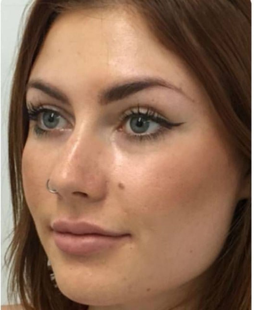 CSD CLINICS | Dermal Filler