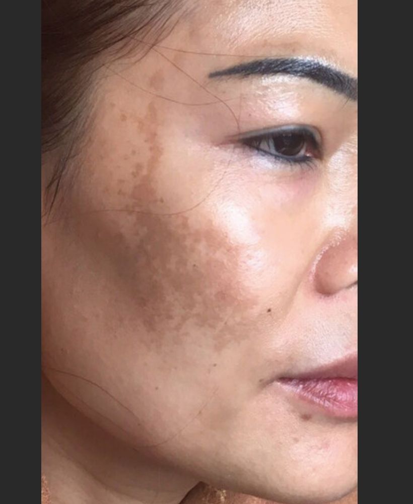CSD CLINICS | Pigmentation