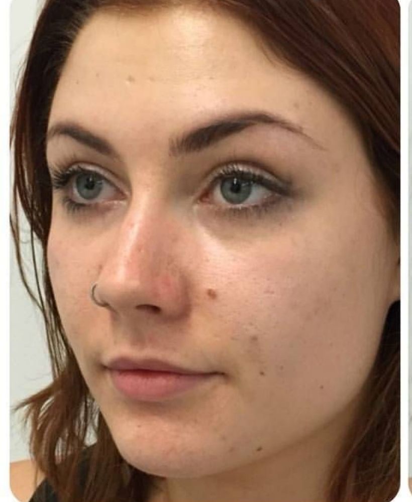 CSD CLINICS | Dermal Filler