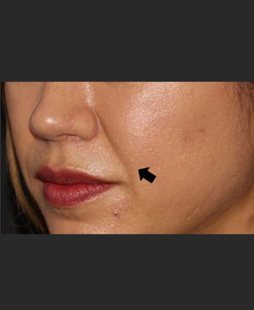 CSD CLINICS | Dermal Filler