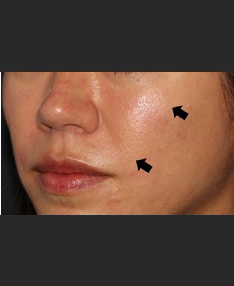 CSD CLINICS | Dermal Filler