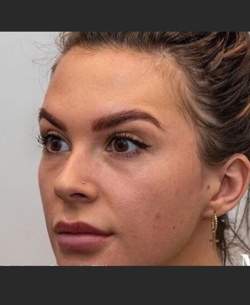 CSD CLINICS | Dermal Filler