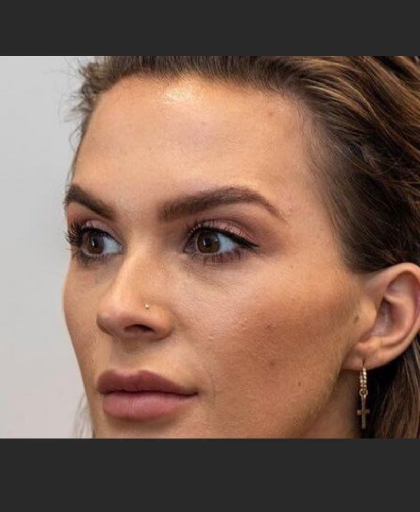 CSD CLINICS | Dermal Filler