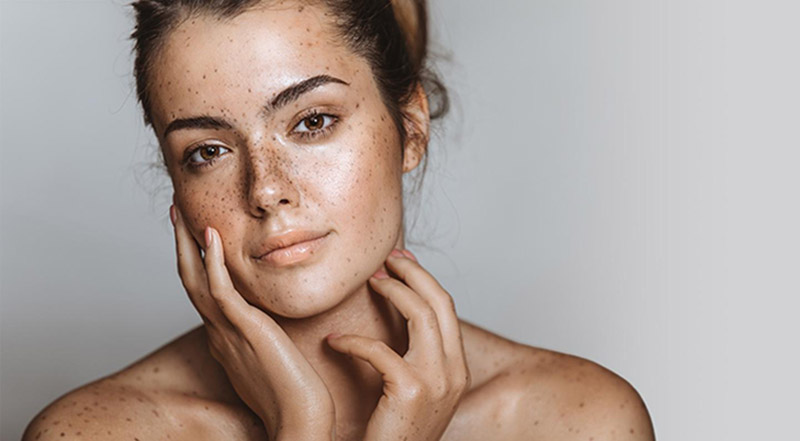 CSD CLINICS | Pigmentation