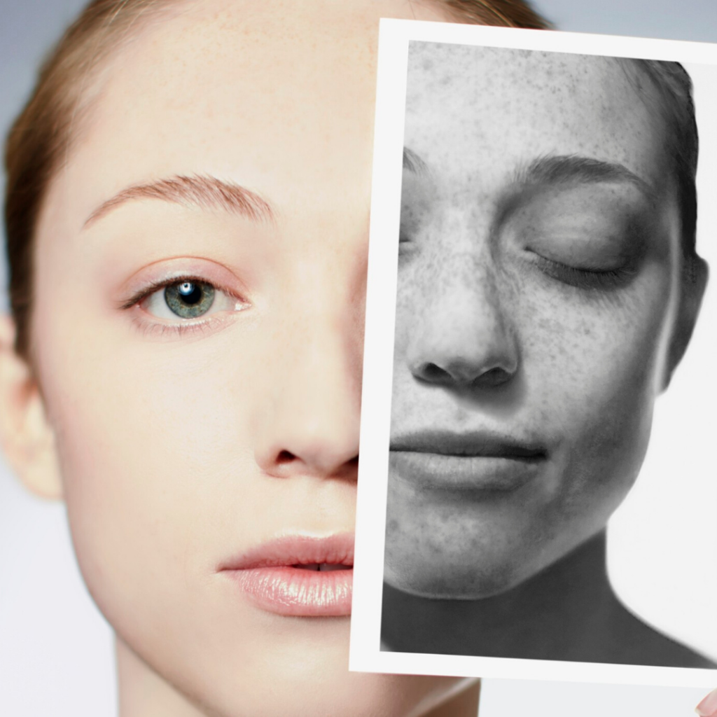 CSD CLINICS | Pigmentation