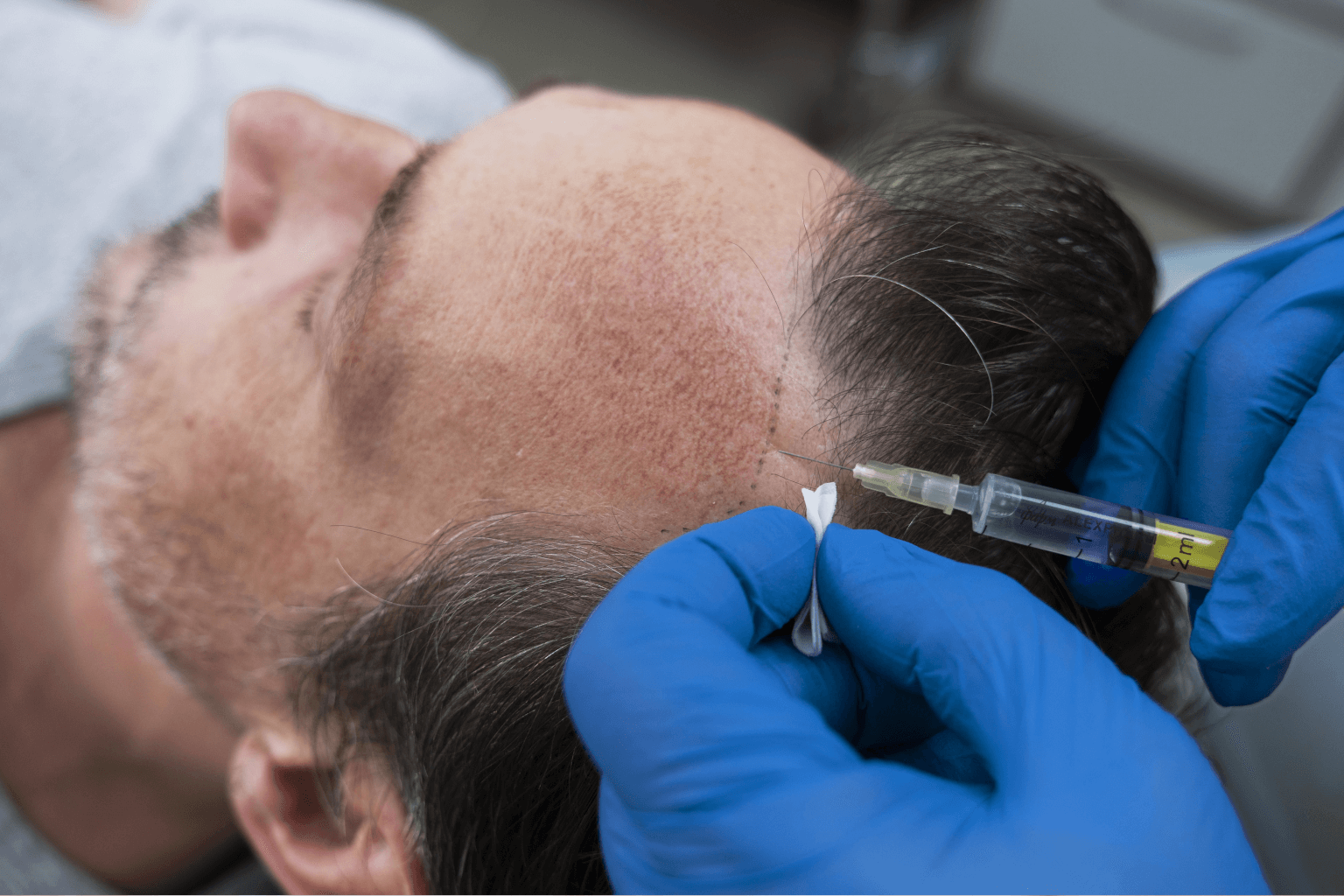 hair- transplant