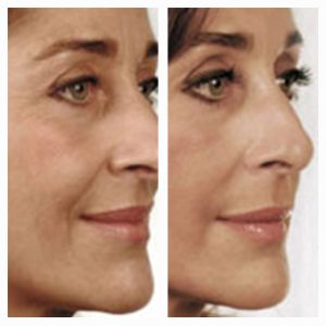 CSD CLINICS | ANTI-WRINKLE INJECTIONS