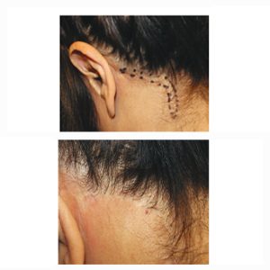 CSD CLINICS | FUE HAIR TRANSPLANT IN MELBOURNE