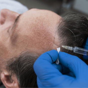 CSD CLINICS | Can Hair Transplant Procedures Give Results that Last?