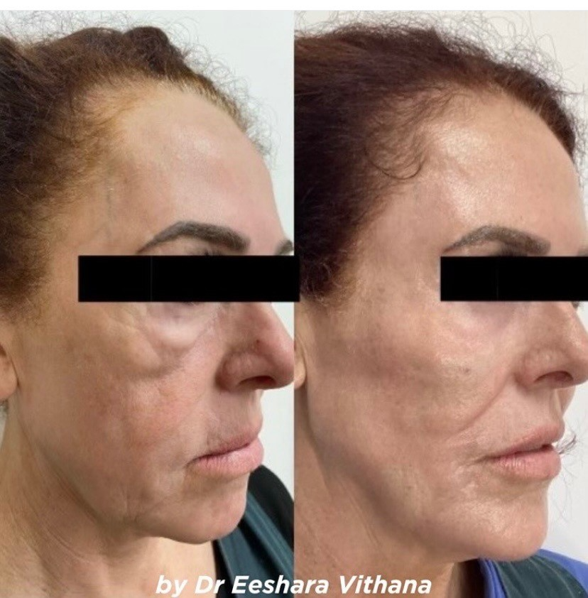 CSD CLINICS | Fractionated Co2 Laser