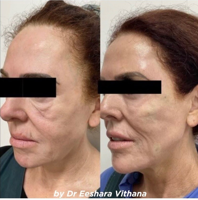 CSD CLINICS | Fractionated Co2 Laser