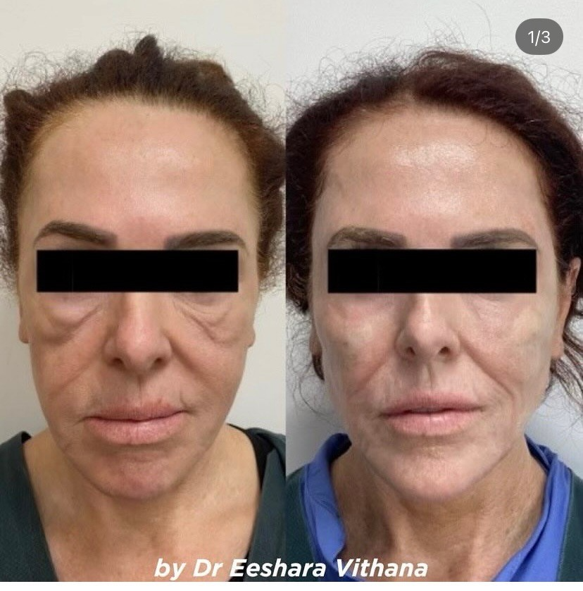 CSD CLINICS | Fractionated Co2 Laser