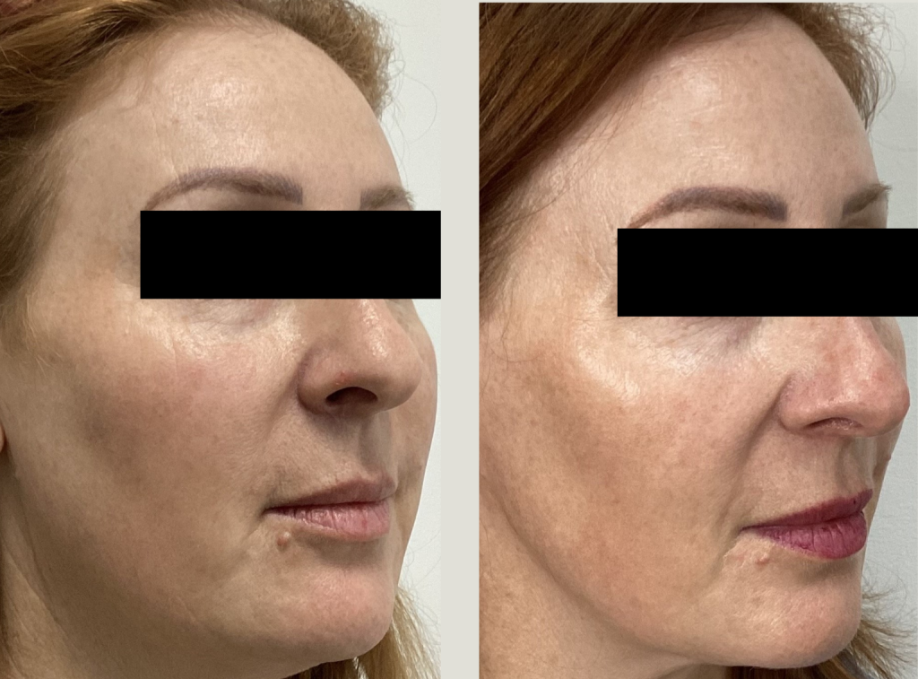 Skin Tightening Melbourne | RF Treatments with Morpheus8, Body FX & More