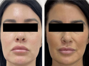 CSD CLINICS | Face Thread Lift