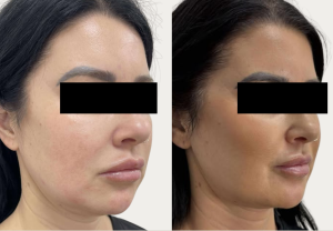 CSD CLINICS | Face Thread Lift