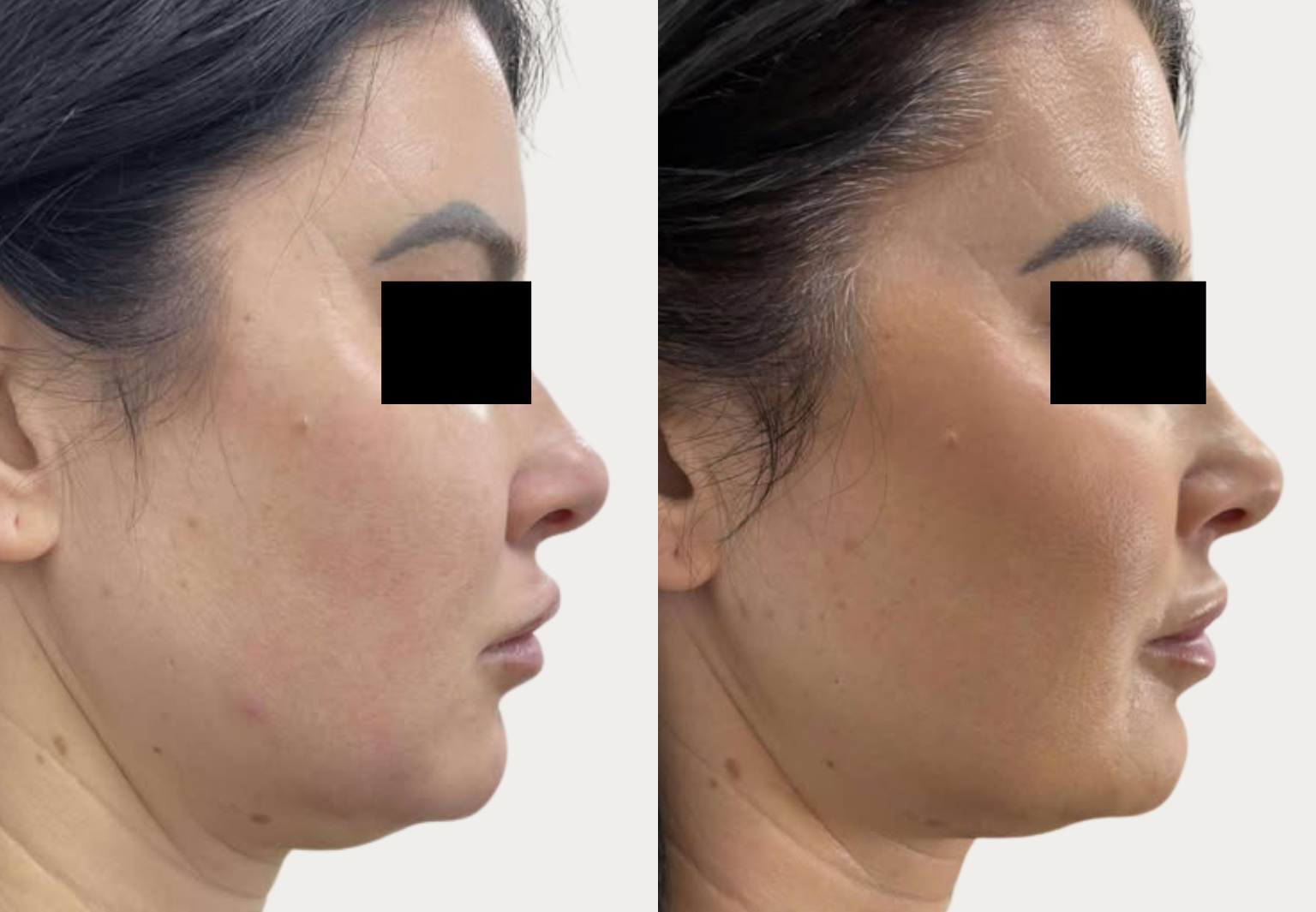 Facetite2 CSD CLINICS | Face Thread Lift