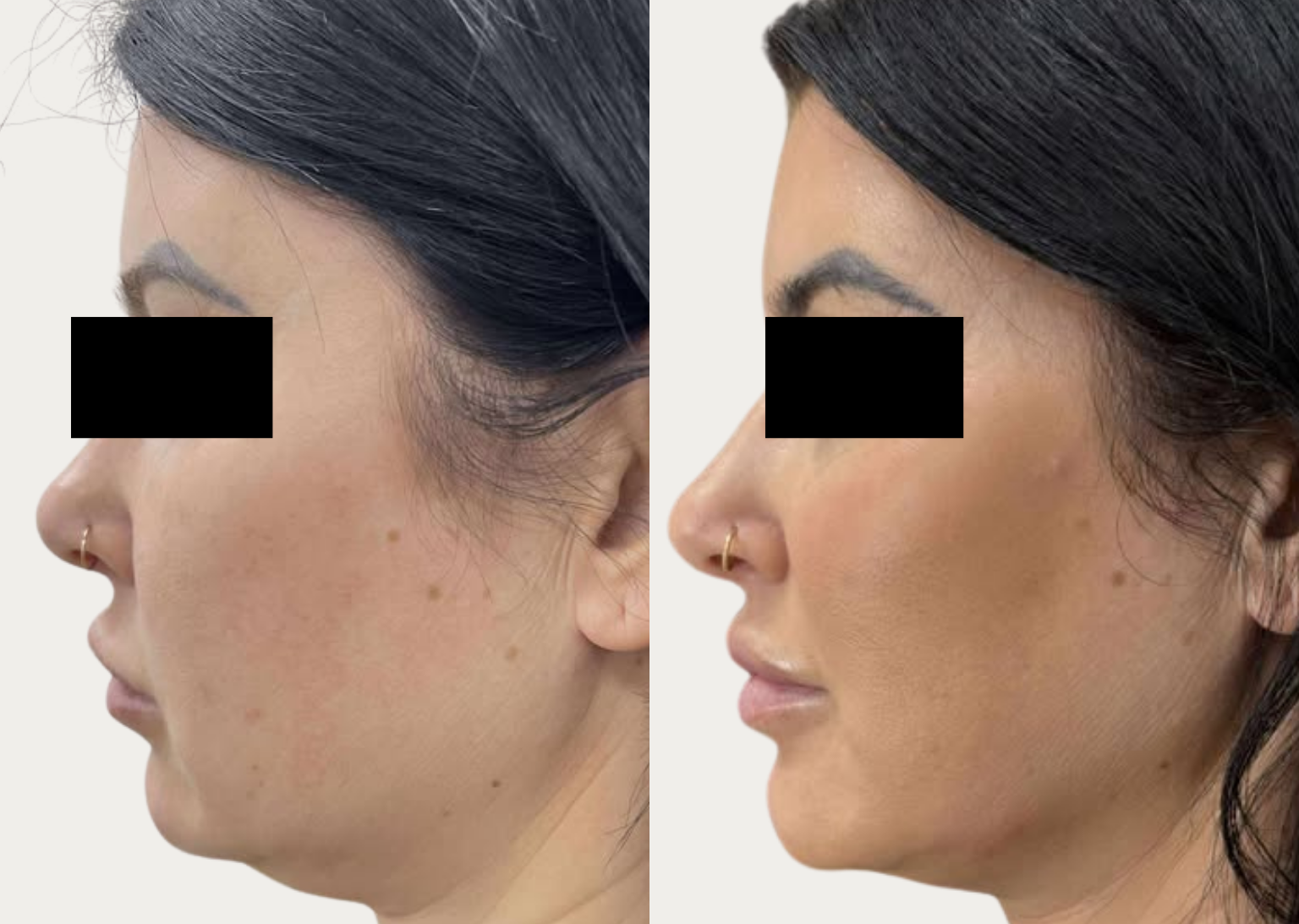 Facetite3 CSD CLINICS | Face Thread Lift