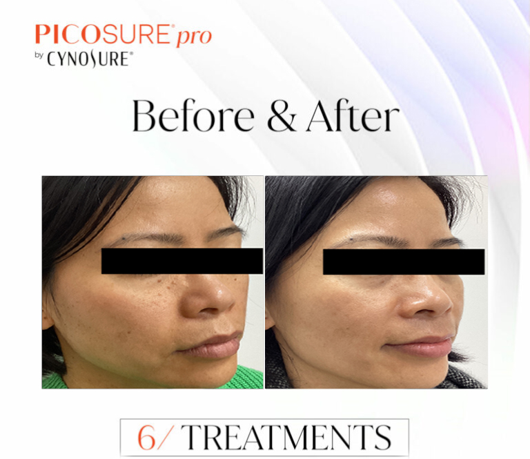 CSD CLINICS | SKIN REJUVENATION WITH PICOSURE PRO IN MELBOURNE