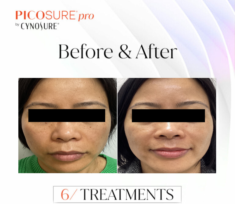 CSD CLINICS | SKIN REJUVENATION WITH PICOSURE PRO IN MELBOURNE