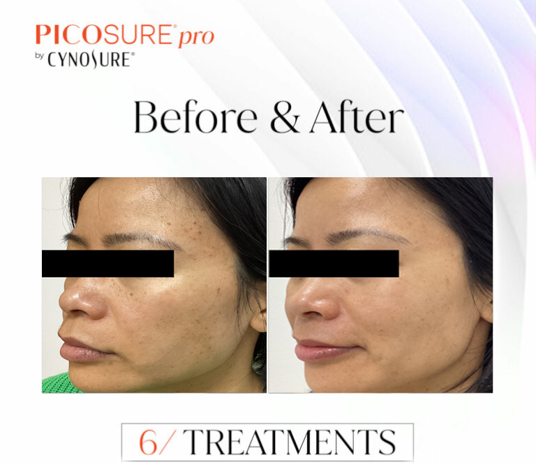CSD CLINICS | SKIN REJUVENATION WITH PICOSURE PRO IN MELBOURNE